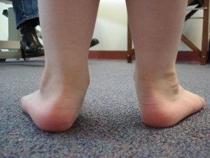 Последствия иксообразных ног