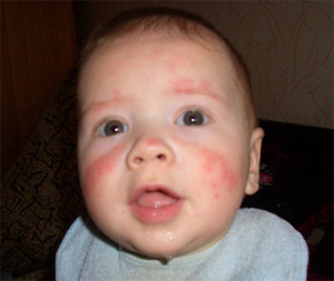 фото проявления диатеза у ребенка