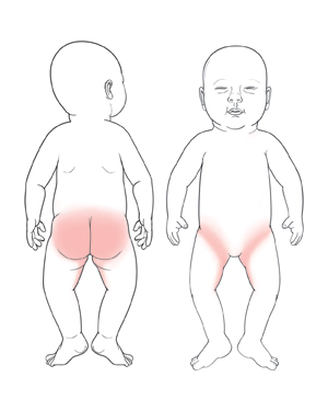 Пеленочные дерматит у ребенка