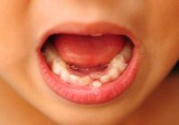 Шатающийся зуб у ребенка