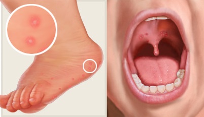 симптомы вируса на ногах и во рту