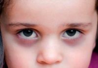Синяки под глазами у ребенка